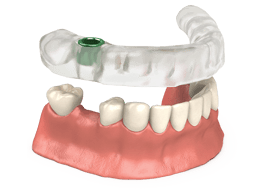 Guia cirúrgico utilizado na cirurgia guiada de implante dentário pelo Dr. Paulo Fernando